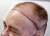 First-ever successful skull and scalp transplant reported