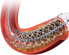 Govt invokes special powers to ensure steady supply of coronary stents