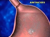 Heartburn, acidity drugs can harm kidneys: study