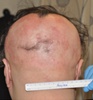 FDA-approved drug restores hair in patients with Alopecia Areata