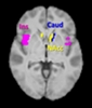 Cravings for high-calorie foods may be switched off in the brain by new supplement