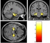 Brain retains signs of childhood trauma — and a warning for substance abuser