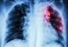 Number of TB cases in India is double current estimates, says new study