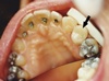 Dental fillings raise levels of mercury in the body, UGA study says