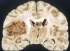 Can fat fight brain cancer?