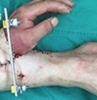 Doctors in China reattach man’s severed hand after keeping it alive for over a month