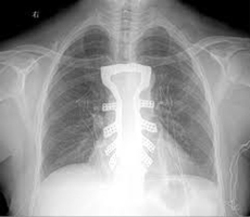 Domain-b.com : Cancer Patient Receives 3D Printed Titanium Sternum And ...