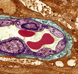 Cell-saving drugs could reduce brain damage after stroke