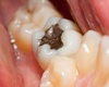 Measuring mercury: common test may overestimate exposure from dental amalgam fillings