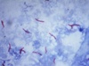 Gastric acid suppressant lansoprazole may target tuberculosis