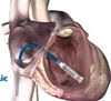 Pacemaker the size of vitamin capsule implanted successfully