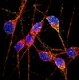 Researchers induce Alzheimer’s neurons from pluripotent stem cells